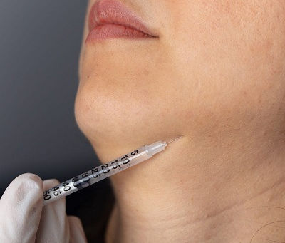 Jawline Fillers and Fitness: Is There an Impact?