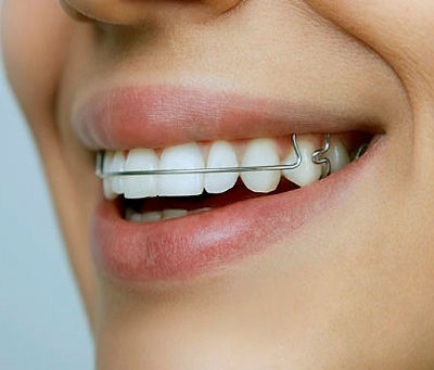 Do Dental Retainers Affect Your Speech?