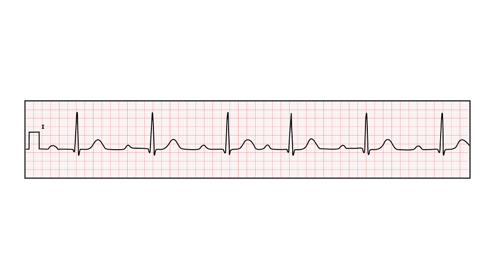 1st degree heart block ECG trace