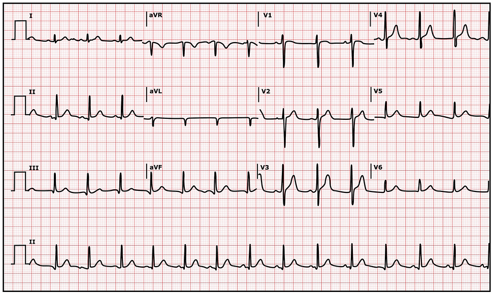 Normal Sinus Rhythm