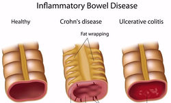 crohn-disease-ulcerative-colitis_edited_edited