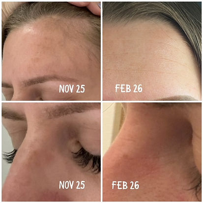 pigmentation on face