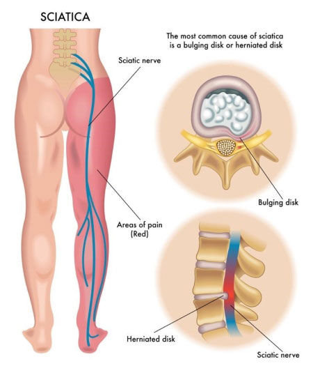 A Practical Guide to Managing Sciatic Nerve Challenges