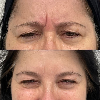 Anti Wrinkle Injections | Aesthetics By Dermad