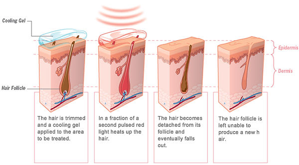 laser-hair-removal.jpg