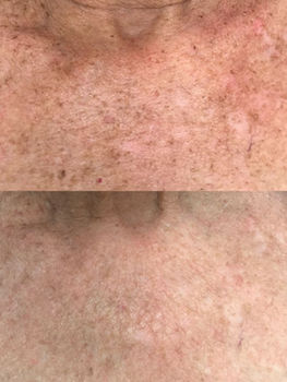 IPL Photofacial for the chest