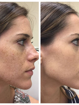 IPL Photofacial before and after.