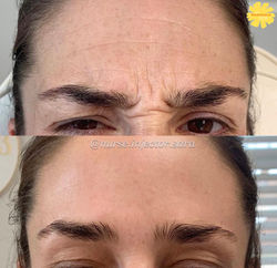 Botox and Dysport for the 11s at The Marigold Spa