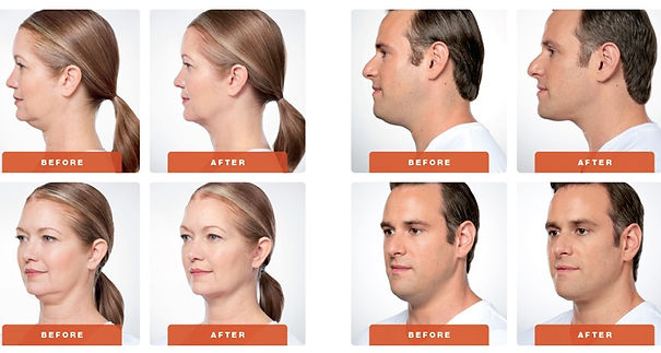Kybella for the doube chin