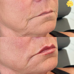 The Marigold Spa Lip Filler 2