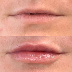 Lip Filler at The Marigold Spa