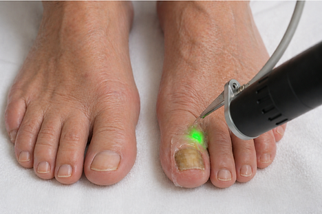 fungal nail laser treatment at define