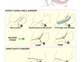 Cholesteatoma Surgery