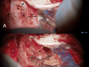 Temporal Bone Surgical Anatomy 3D Course and Laboratory Dissection.Course Instructor and Organizer