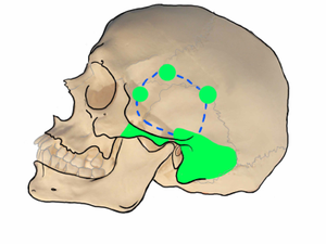 Grand Rounds “Lateral Skull Base Approaches for Aneurysms”