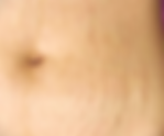 Revise Your Stretch Marks with Paramedical Tattooing Techniques