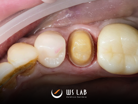 Como Erros no Preparo Dentário Impactam a Adaptação das Próteses no Laboratório