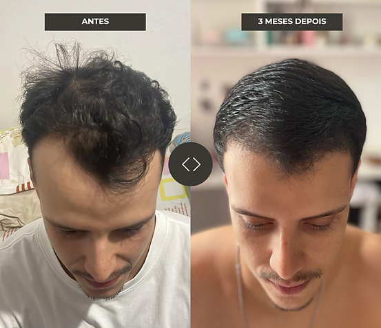 Transplante Capilar Masculino