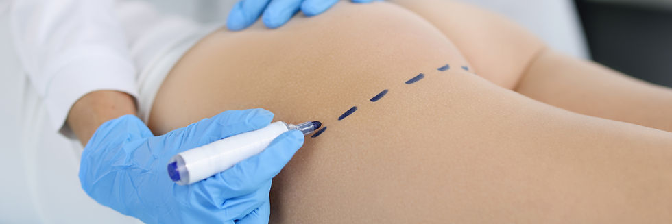 doctor-draws-marks-patients-buttocks-with-marker-body-shaping.jpg
