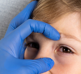 a child with red purulent eyes from conjunctivitis, childhood eye disease, allergies in a