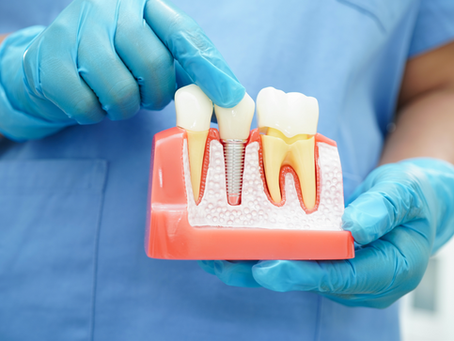 Dental Implants as a Tooth Replacement Option