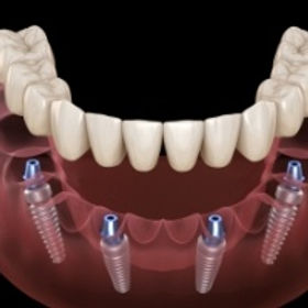 dental-implants-8.jpg