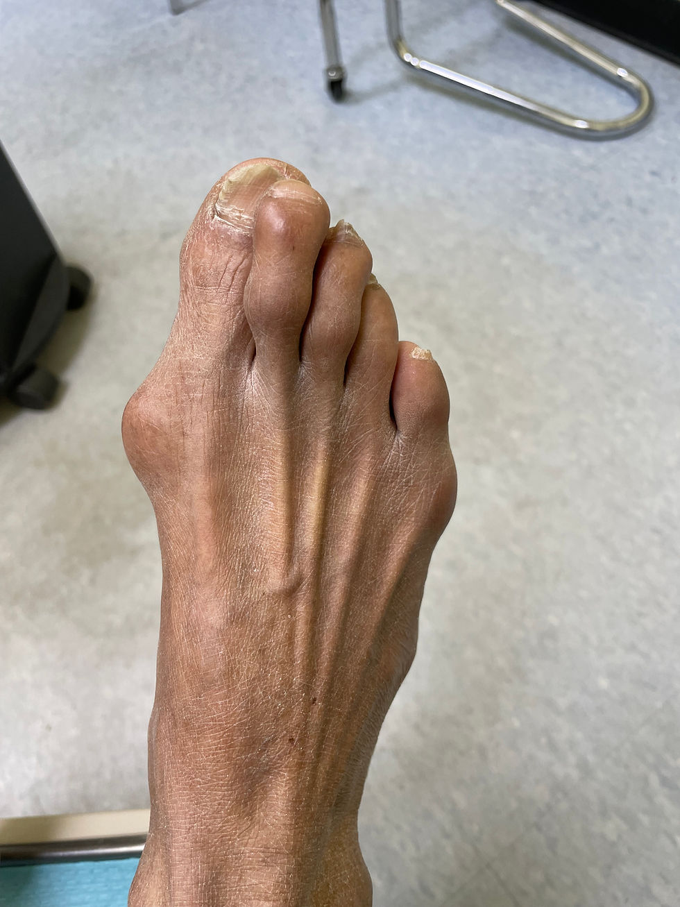 Minimally Invasive Bunion & Hammertoe Surgery: A Modern Approach to Foot Pain Relief