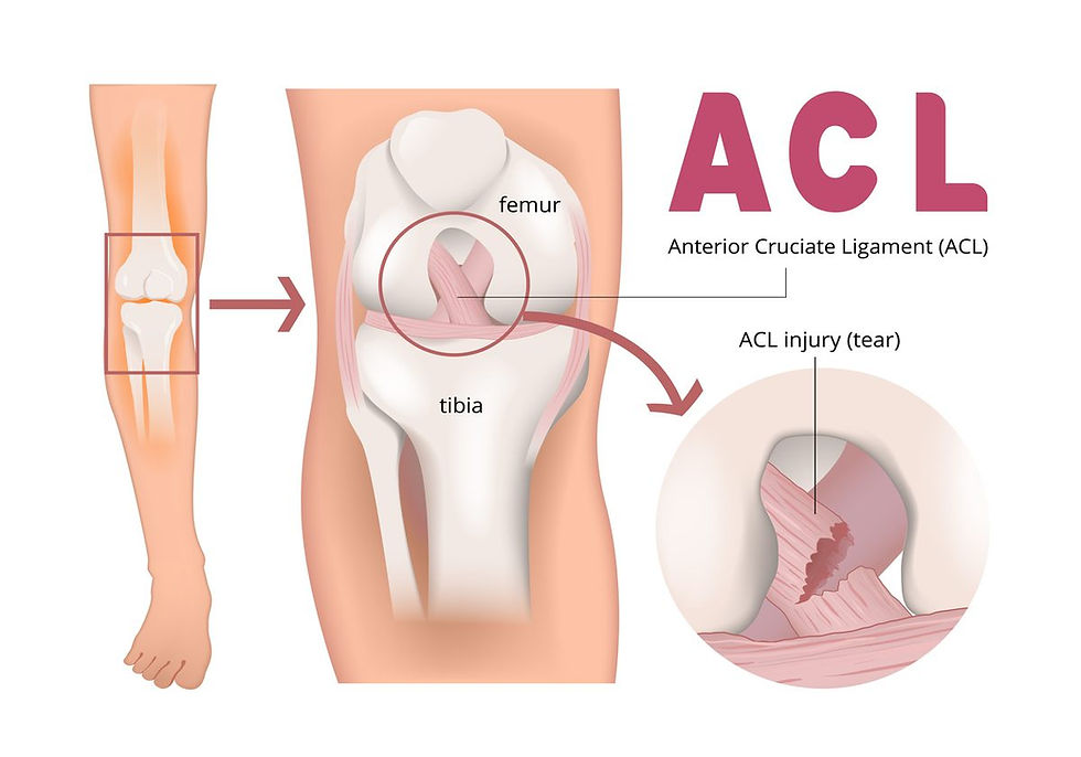 Diagram of the anterior cruciate ligament between the femur and tibia showing an ACL tear