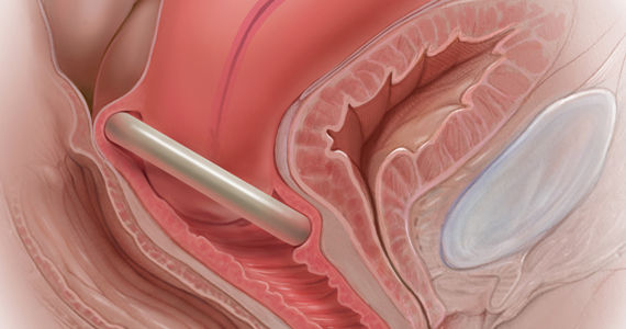 Medical illustration showing a side view of the female pelvis with a pessary inserted in the vagina to support pelvic organs such as the bladder and uterus.