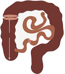 Cystectomy and Urinary Diversion 10.png