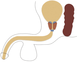 Figure for Urethral Obstruction after PCT.png
