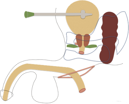 Fig. 10: Male pelvic anatomy with pelvic fracture (side-view).