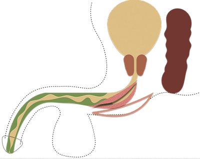 Panurethral Stricture Surgery 05.png