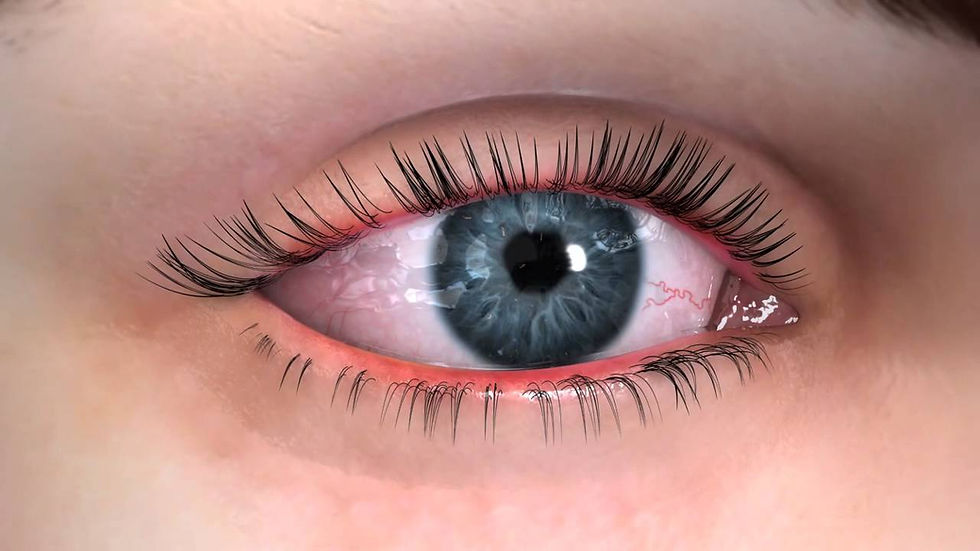 Monitoring Dry Eyes