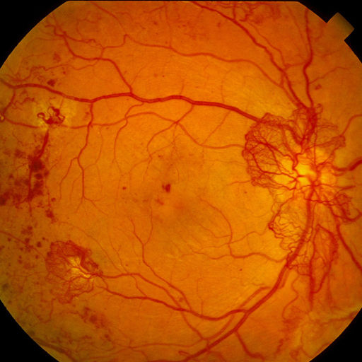 Diabetic Eye Exams