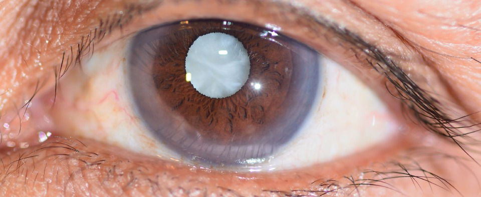 Monitoring Cataracts