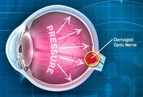 Monitoring Glaucoma