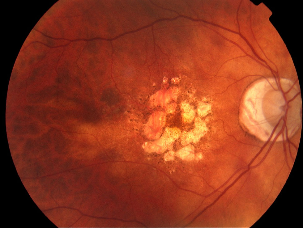 Monitoring Macular Degeneration
