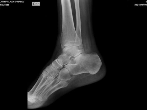 Bronca e indignación: salió a pasear con sus nietos y terminó con una fractura por los pozos en la plaza