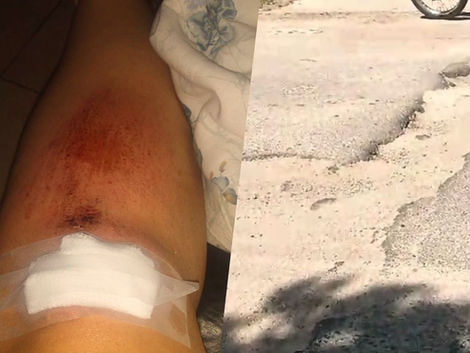 Volvía del trabajo, cayó en moto y tuvo que recibir puntos por un bache de una obra inconclusa