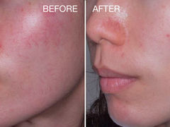 PROYELLOW BEFORE AFTER TELANGIECTASIA