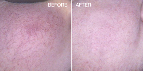 PROYELLOW BEFORE AFTER ROSACEA