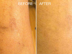 PICOSTAR BEFORE AFTER SCAR