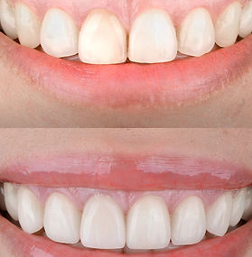 Gummy-Smile-Korrektur