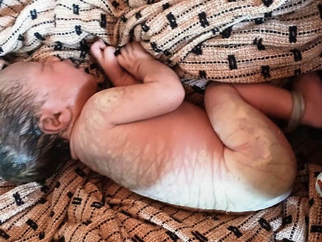 Agente comunitária acompanha parto emergencial em domicílio e evidencia papel da atenção básica