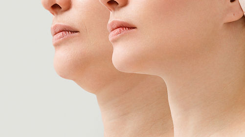 Non Surgical Laser Chin Tightening & Neck Tightening