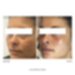 Thumbnail: DERMAL FILLER - ONE SYRINGE