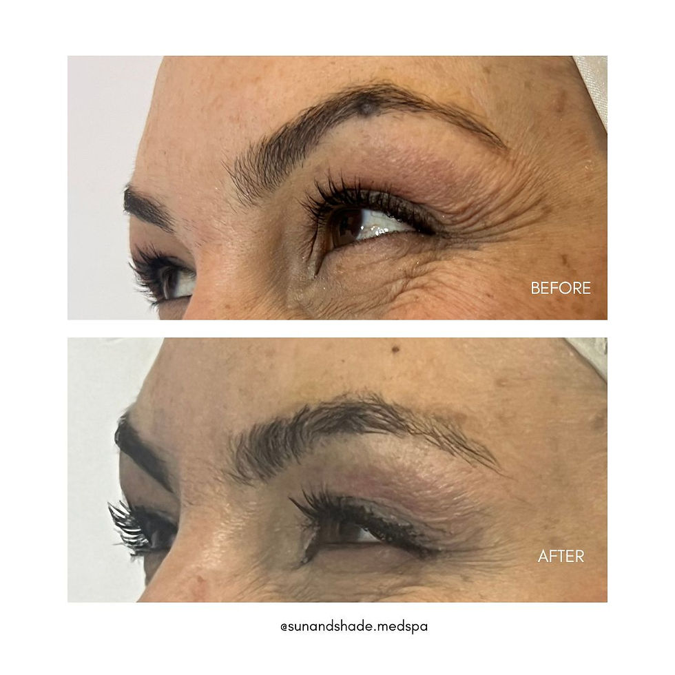 Thumbnail: BOTOX / DYSPORT ® - 25 UNITS