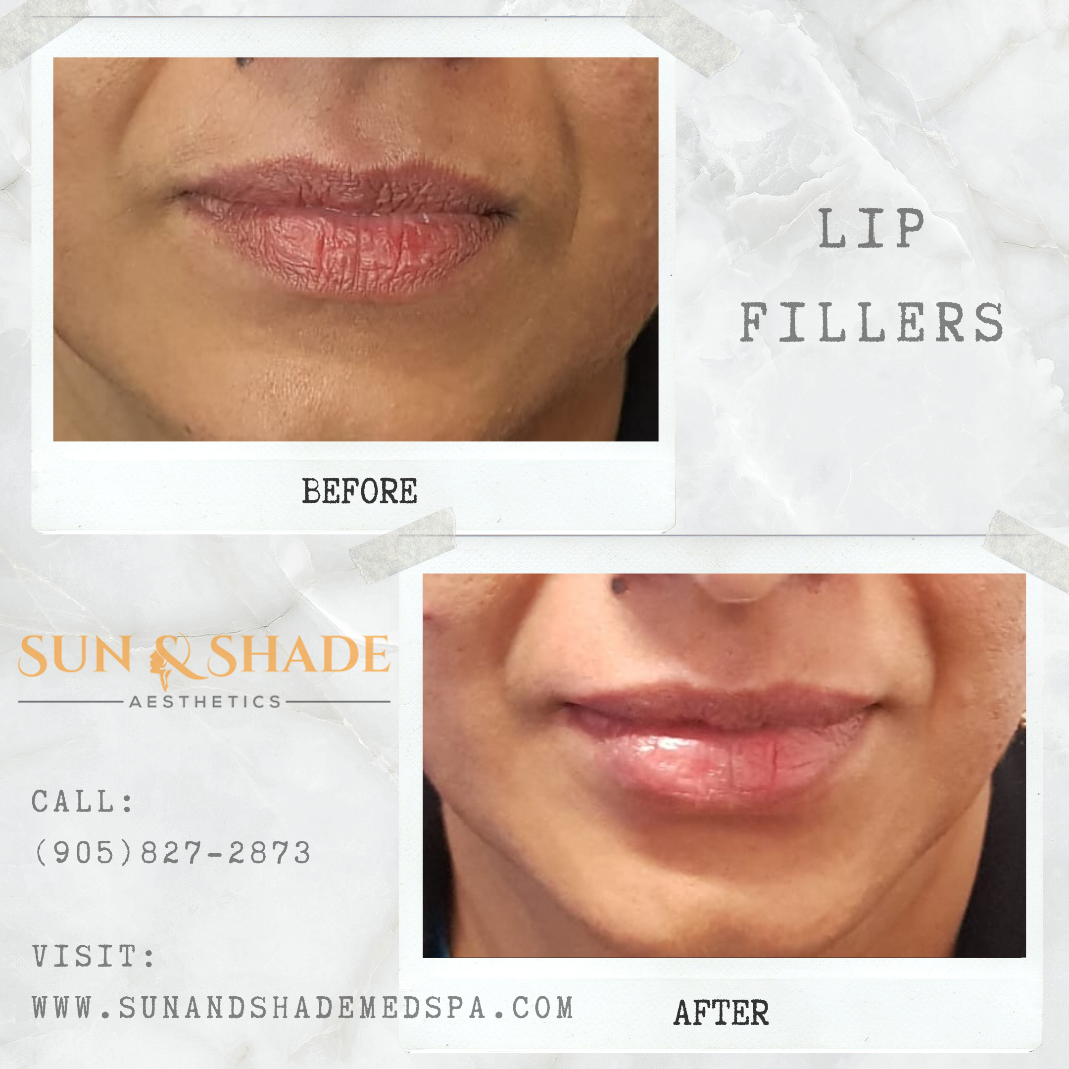 kysse lip filler kysse lip filler
