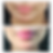 Thumbnail: DERMAL FILLER - ONE SYRINGE